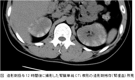 図 造影剤投与12時間後に撮影した腎臓単純CT：楔形の造影剤残存（腎虚血）所見