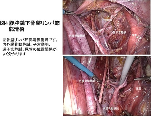 図4 腹腔鏡下骨盤リンパ節郭清術