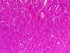 図2 胃癌の組織像