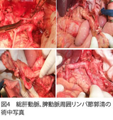図4　総肝動脈、脾動脈周囲リンパ節郭清の術中写真