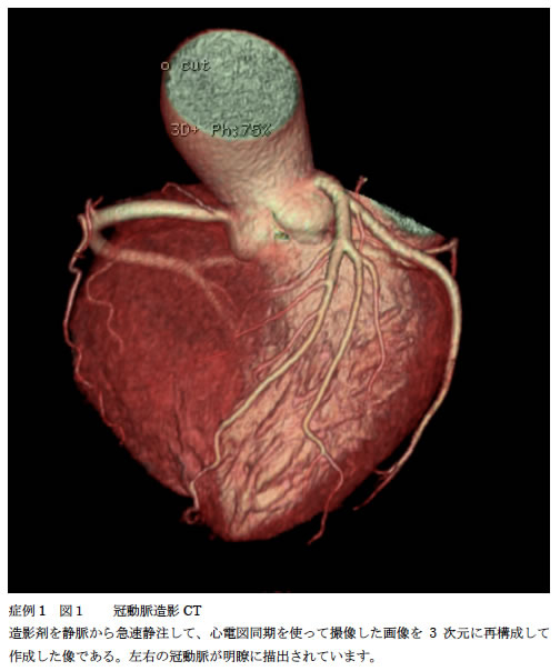症例1　図1　冠動脈造影CT