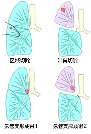 区域切除／肺葉切除／気管支形成術1／気管支形成術2