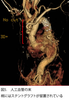 図5.　人工血管の末梢にはステントグラフトが留置されている