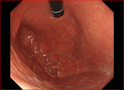 図1．胃底部に発生した隆起型の早期胃がん（黄色線で囲んだ部分）