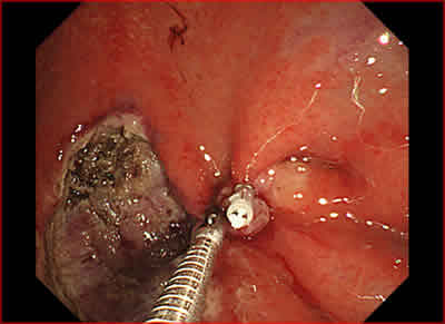 図7．クリップ装置を用いて切除後潰瘍を縫縮